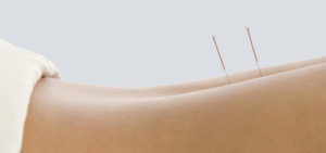 dry needling at roche injury clinic