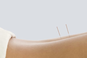 dry needling at roche injury clinic